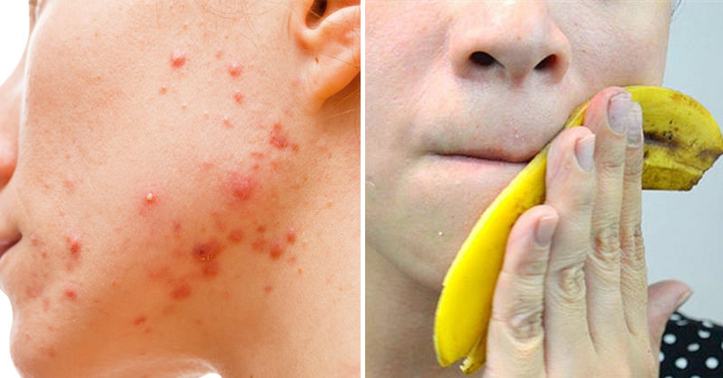 Image result for pimples banana