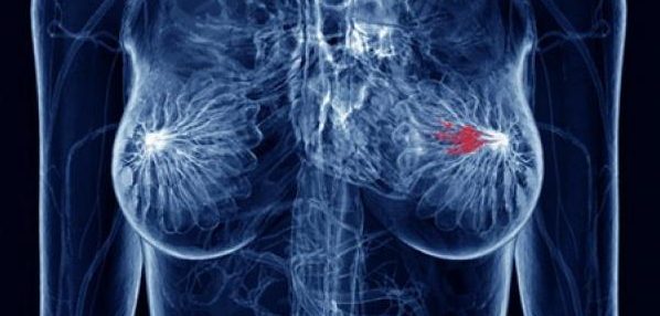 Image result for breast or lung cancer