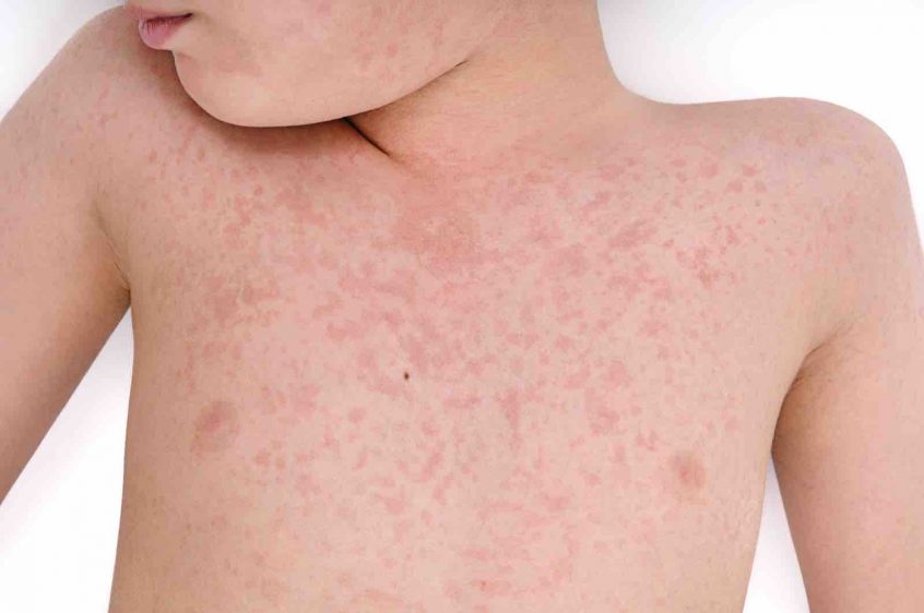 Image result for allergic reaction