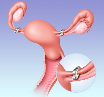 Image result for Tubal Ligation