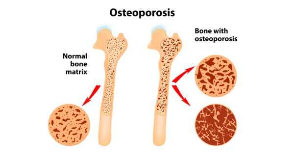 http://158.69.55.95/wp-content/uploads/2018/06/Osteoporosis.jpg